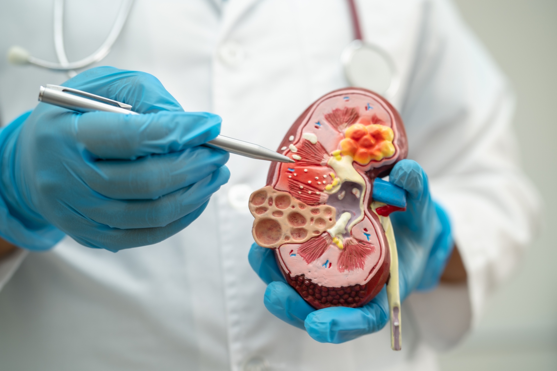A brief overview of kidney disease